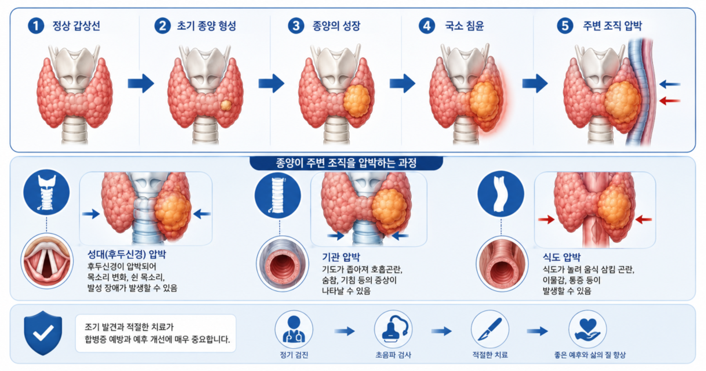 갑상선암의 진행 과정과 주변 조직(식도, 기도) 압박 흐름도