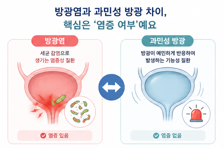 방광염은 세균 감염 과민성 방광은 방광 과민 반응으로 발생한다는 차이를 설명한 인포그래픽